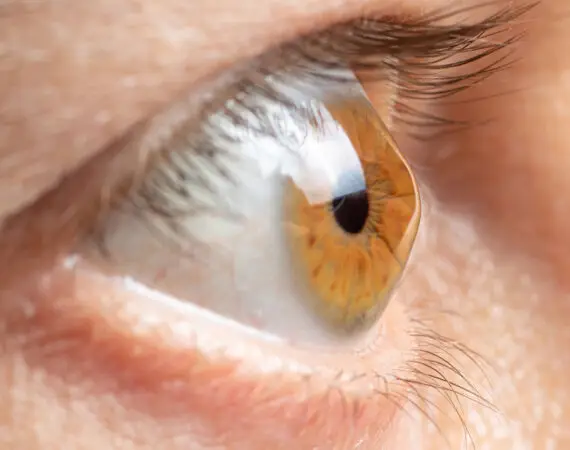 blog-image-corneal-ectasia