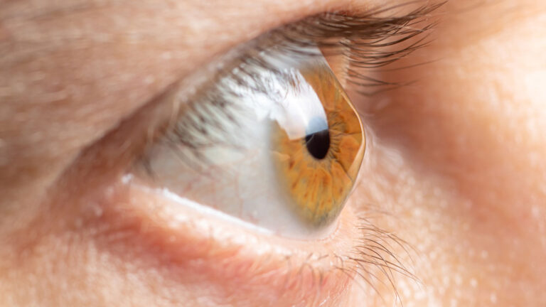 blog-image-corneal-ectasia