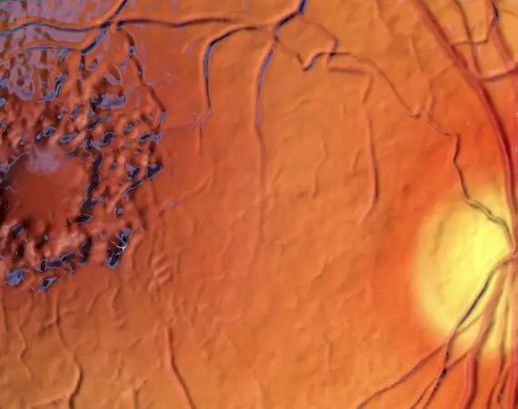 blog-image-macula-oedema-2
