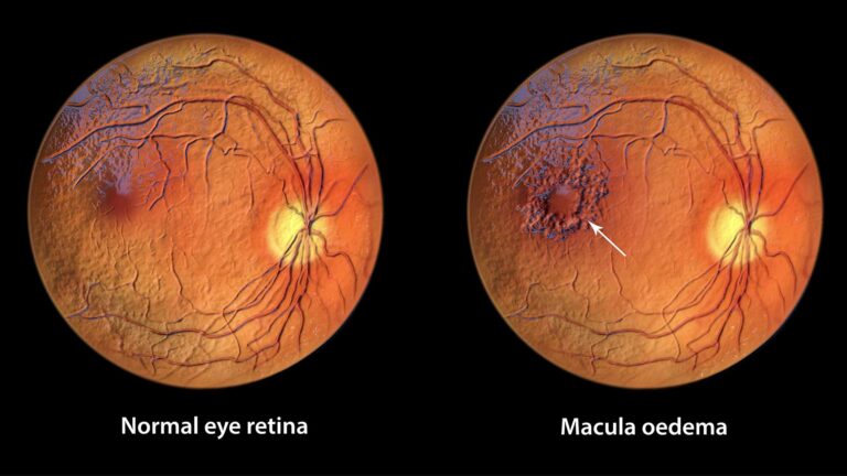 blog-image-macula-oedema