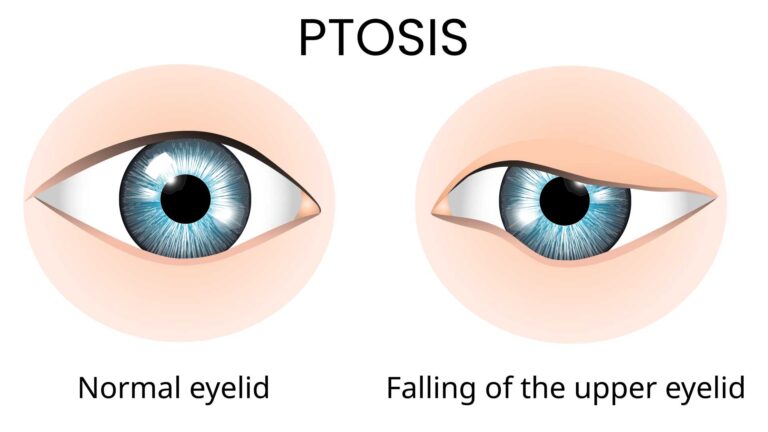 blog-image-ptosis