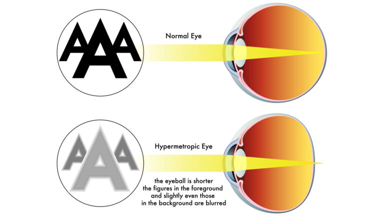 blog-image-hyperopia