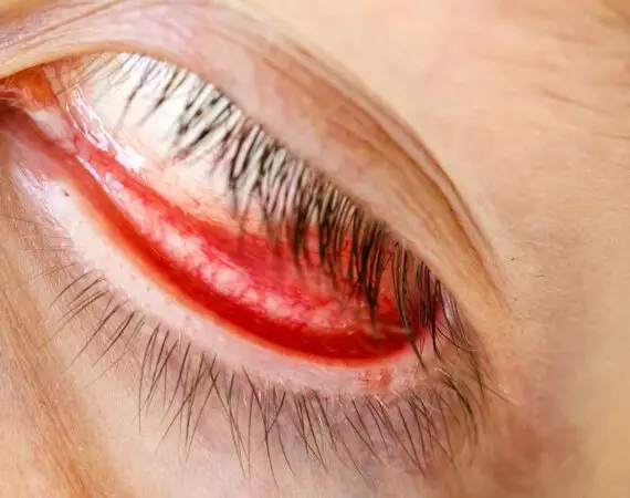 blog-image-meibomian-gland-dysfunction-1