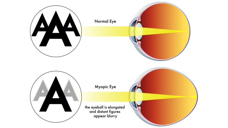 blog-image-myopia