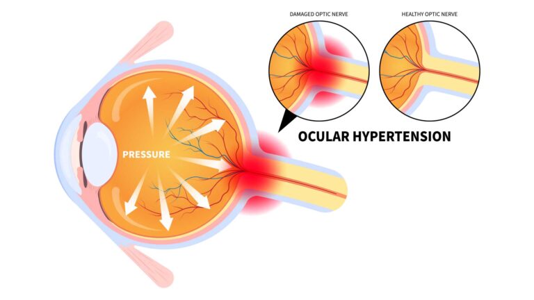 blog-image-ocular-hypertension