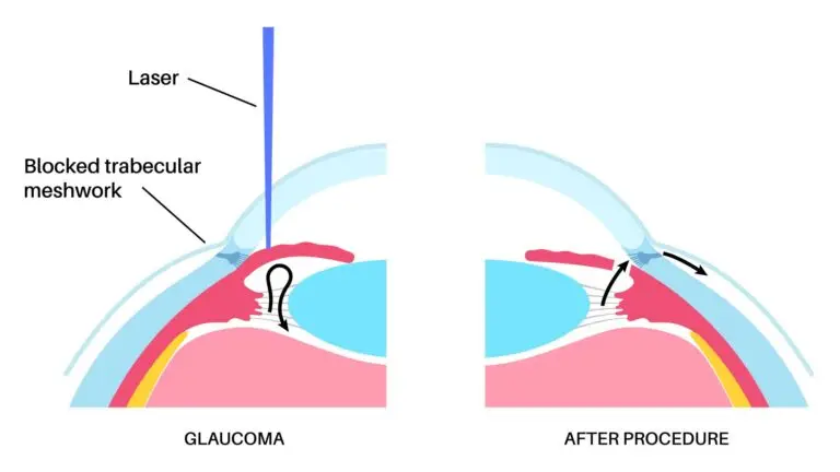 blog-image-yag-laser-iridotomy-1