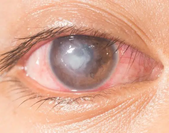 blog-image-corneal-ulcer-1