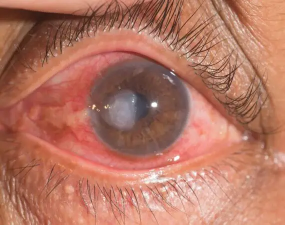 blog-image-corneal-ulcer-2