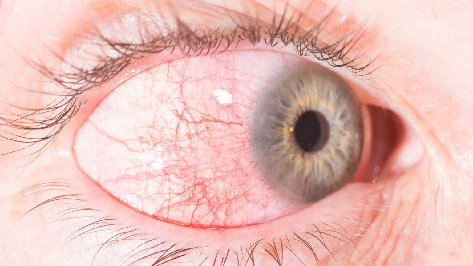 Unravelling Eye Inflammation Episcleritis Vs Scleritis