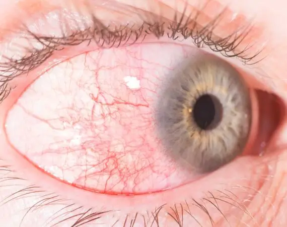 blog-image-episcleritis