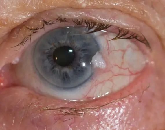 blog-image-eye-cancer