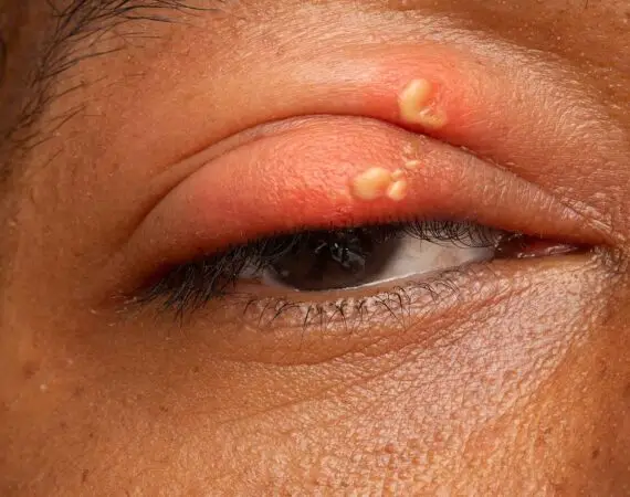 blog-image-eye-herpes