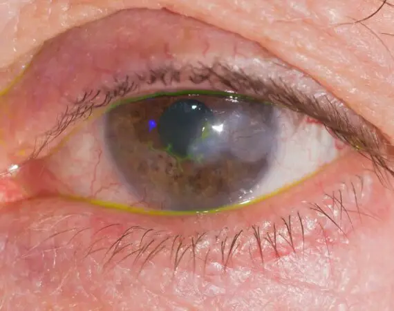 blog-image-herpes-keratisis