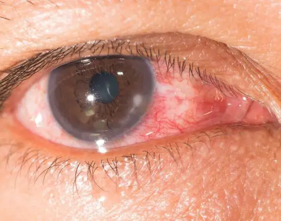 blog-image-keratitis