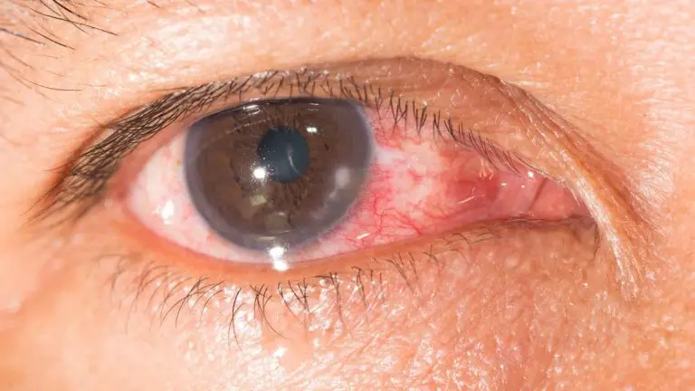 blog-image-keratitis