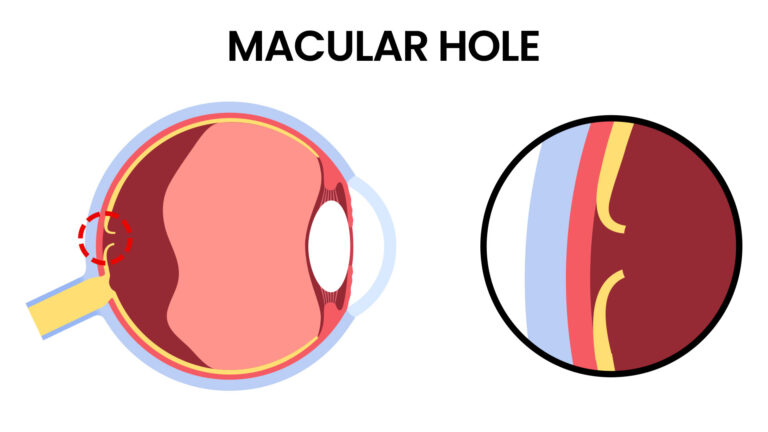 blog-image-macular-hole-2