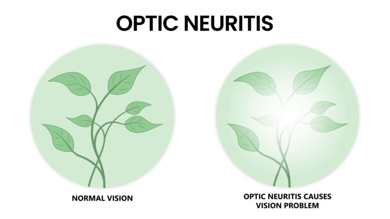 blog-image-optic-neuritis-2