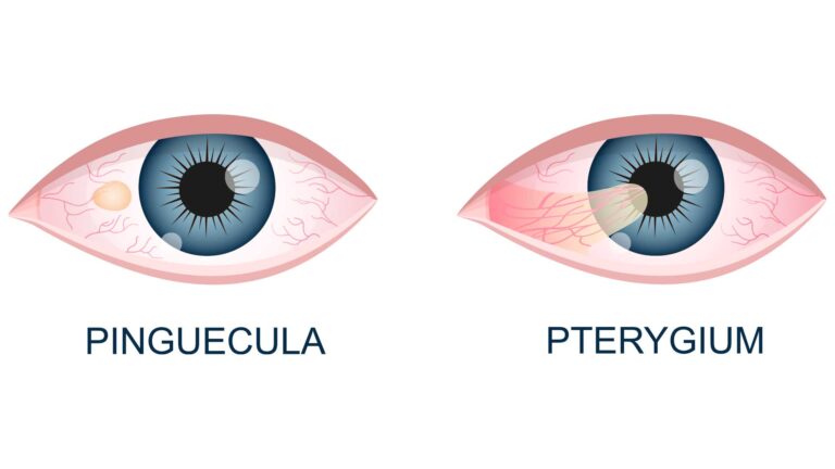 blog-image-pinguecula-vs-pterygium-2