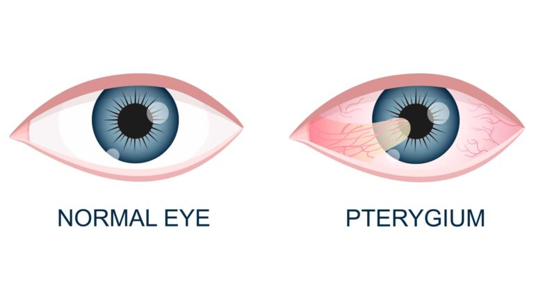 blog-image-pterygium-1