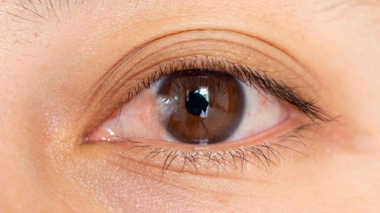 blog-image-pterygium-2