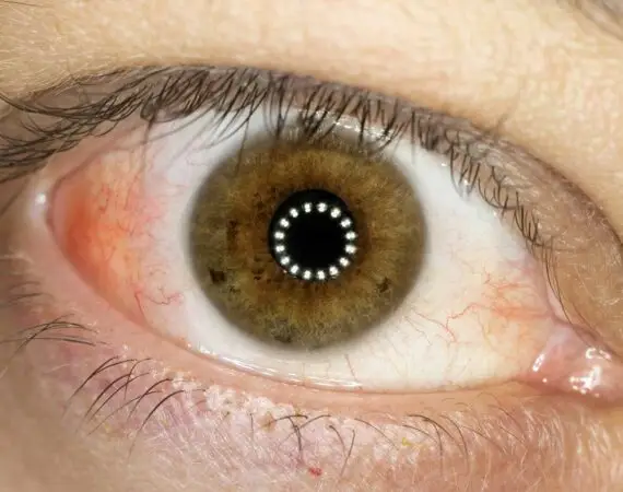 blog-image-scleritis