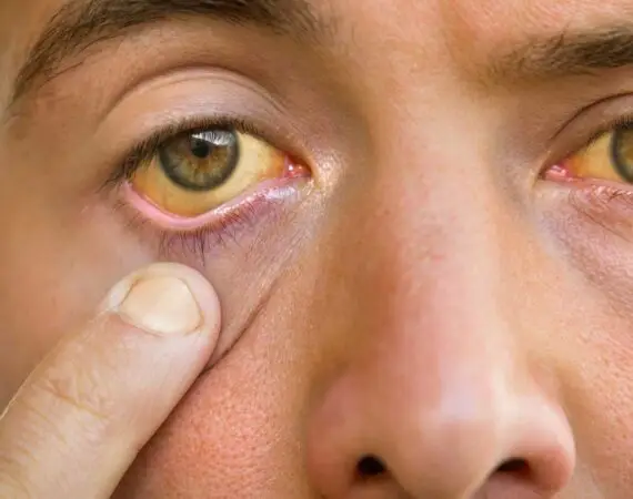 blog-image-yellow-eyes-2
