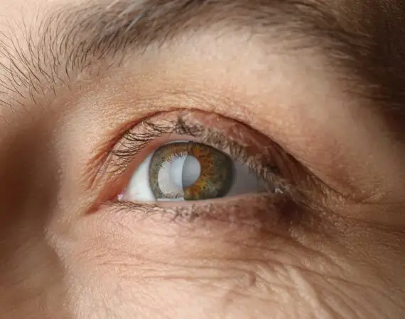 blog-image-cataract-10