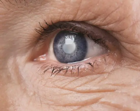 blog-image-cataract-11