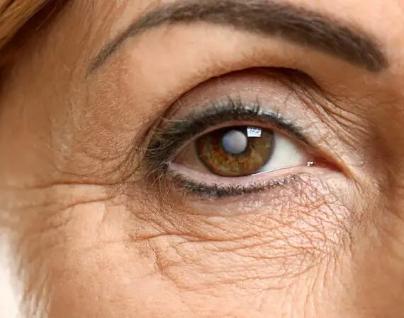 blog-image-cataract-8