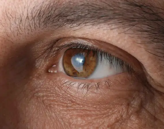 blog-image-cataract-9