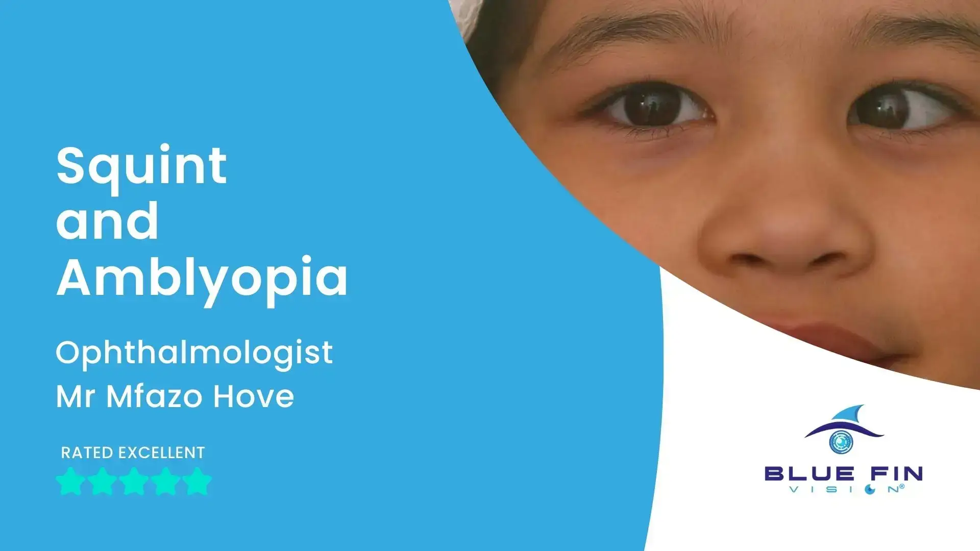 Squint and Amblyopia | Signs & Treatments