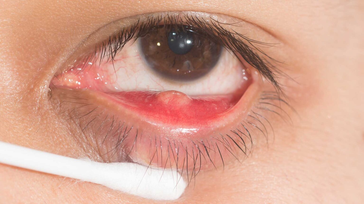 Chalazion On Eyelid Here s What You Need To Know Chalazion On Eyelid Here s What You Need To Know