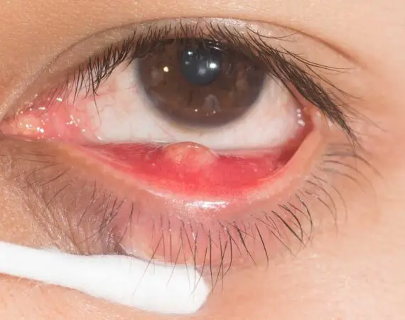 blog-image-chalazion-4