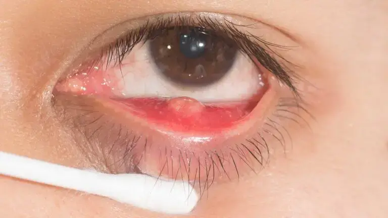 blog-image-chalazion-4
