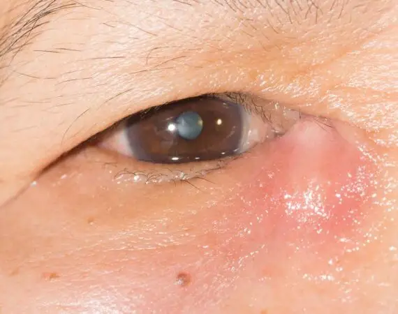 blog-image-dacryocystitis