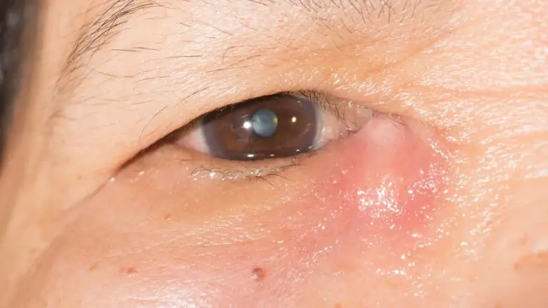 blog-image-dacryocystitis