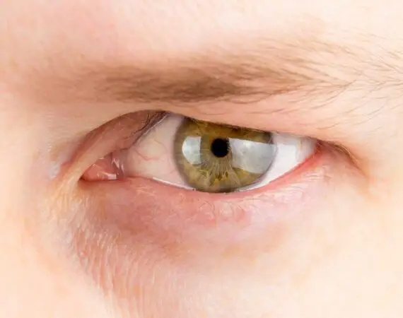 blog-image-dermatochalasis-2