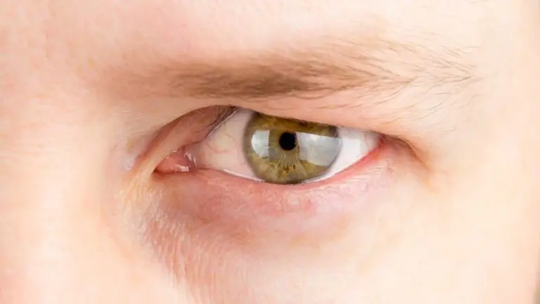 blog-image-dermatochalasis-2