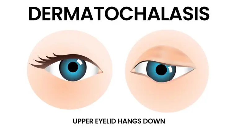 blog-image-dermatochalasis
