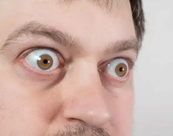 blog-image-graves-disease-2