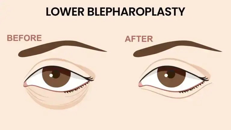 blog-image-lower-blepharoplasty