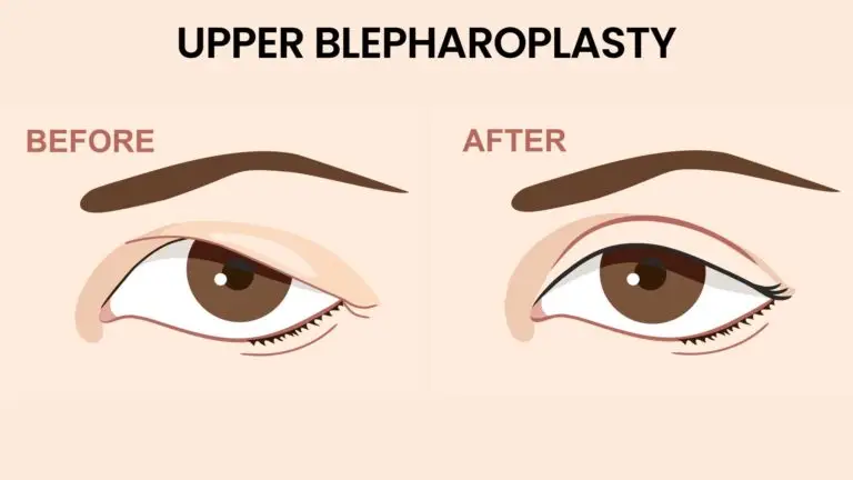 blog-image-upper-blepharoplasty