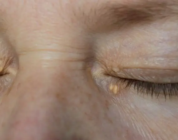 blog-image-xanthelasma