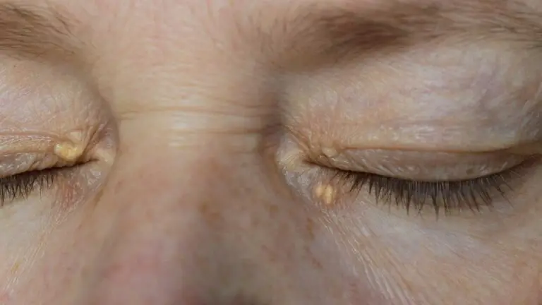 blog-image-xanthelasma