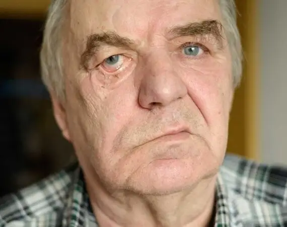 blog-image-facial-palsy