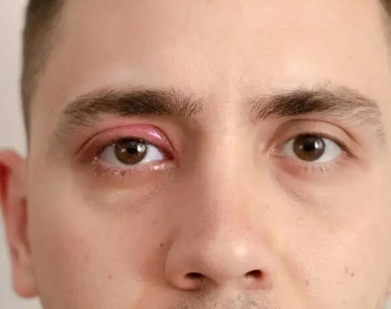 blog-image-orbital-cellulitis-4