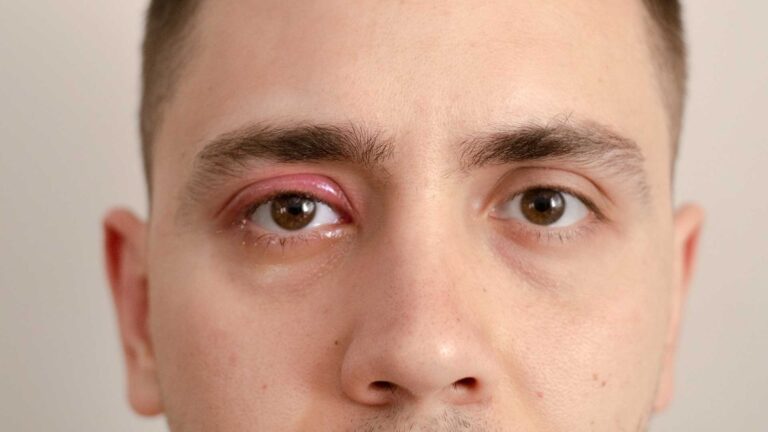 blog-image-orbital-cellulitis-4