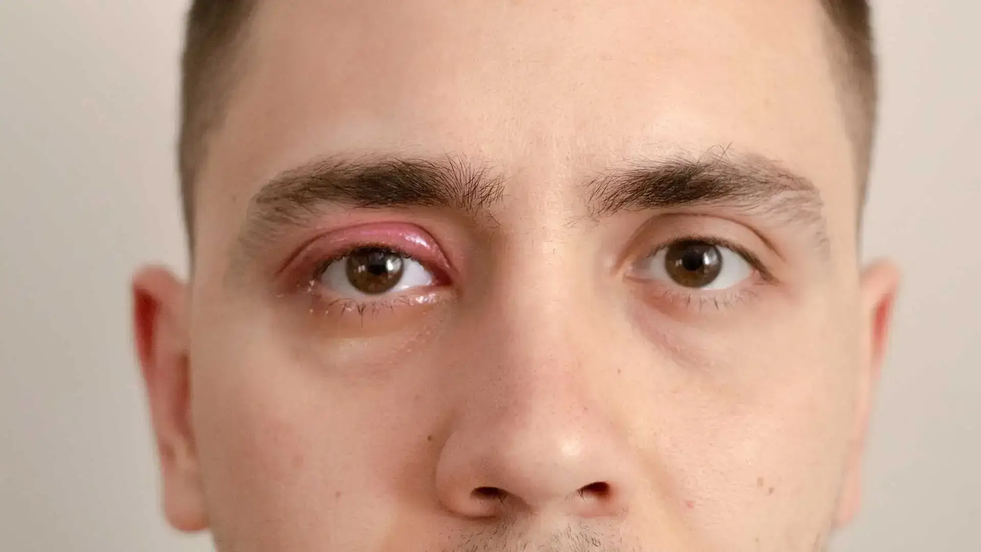 What Is Orbital Cellulitis