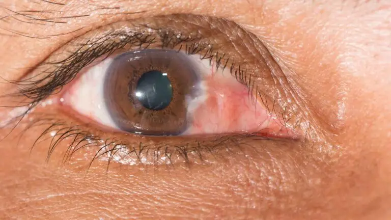 blog-image-pterygium-3