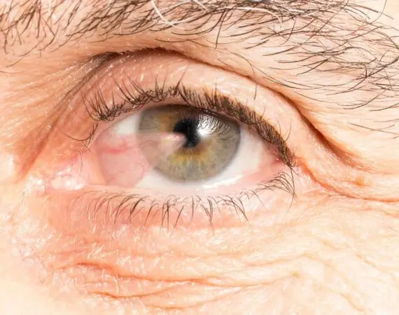 blog-image-pterygium-4